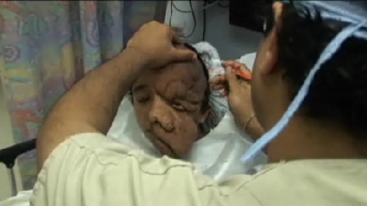 好吧  水水 给你看个面瘫的重度患者